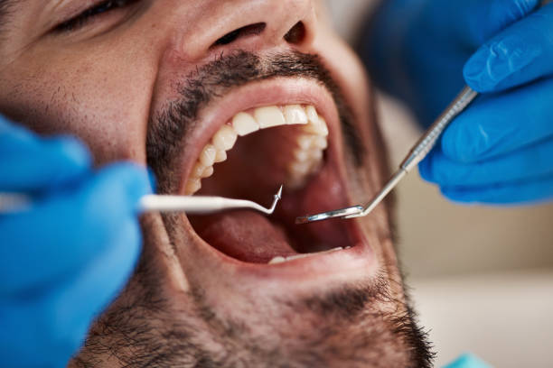 Best Emergency Wisdom Teeth Removal in Lake Isabella, MI