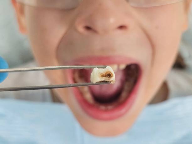 Best Emergency Tooth Extraction in Lake Isabella, MI